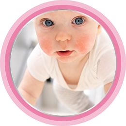 Атопический дерматит у детей