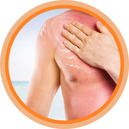 Обработка и лечение ожогов